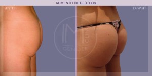 Before and after pictures of buttock augmentation (bottom surgery)
